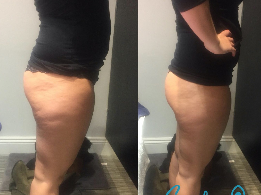 Non-Surgical plus FREE laser Lipo Non-Surgical plus FREE laser Lipo
