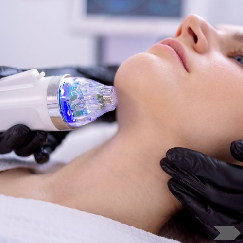 RF Microneedling